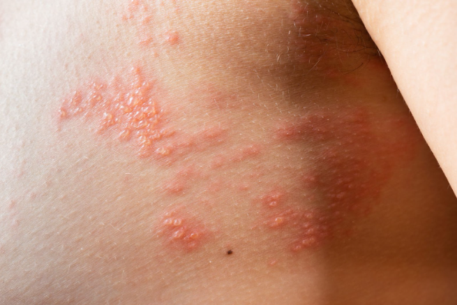 Симптомы при пятнах и бляшках на коже